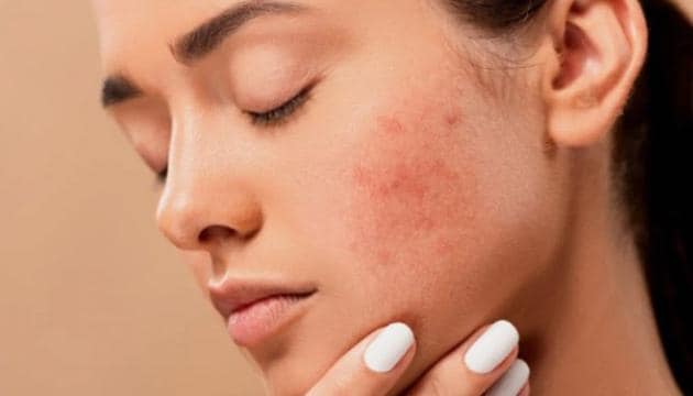 Moisturize Your Dry Skin With Therapy Lotion